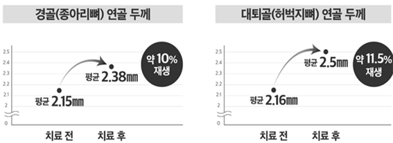 논문출처: Intra-articular injection of expanded autologous bone marrow mesenchymal cells in moderate and severe knee osteoarthritis is safe 