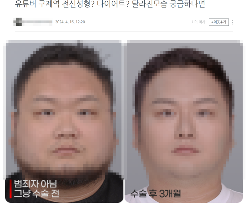 현재는 삭제된 A성형외과 블로그에 올라왔던 유튜버 구제역 수술 전·후 사진. (사진=A성형외과 블로그 갈무리)
