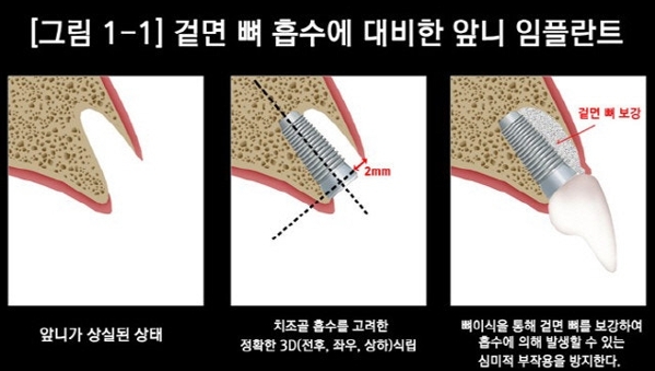 (사진=수플란트치과병원 제공)
