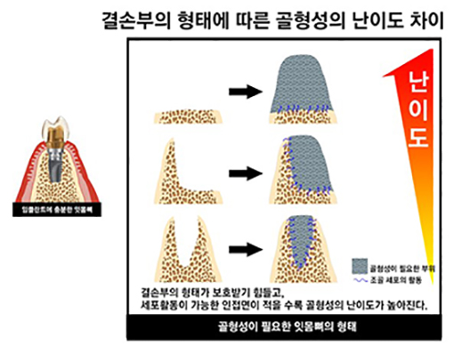 (사진=수플란트치과병원 제공)