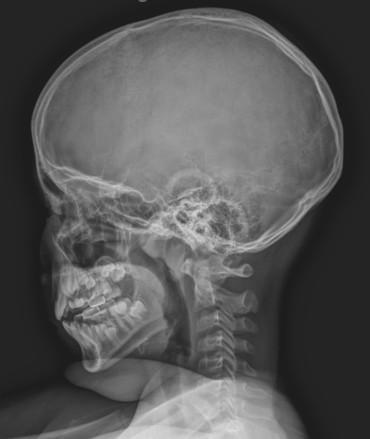 측면 두개·경추 X-ray 영상. 거북목 및 경추 정렬 평가에 활용되는 검사 장면 (사진=함소아한의원 목동점 제공)