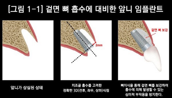 (그래픽=수플란트치과병원 제공)